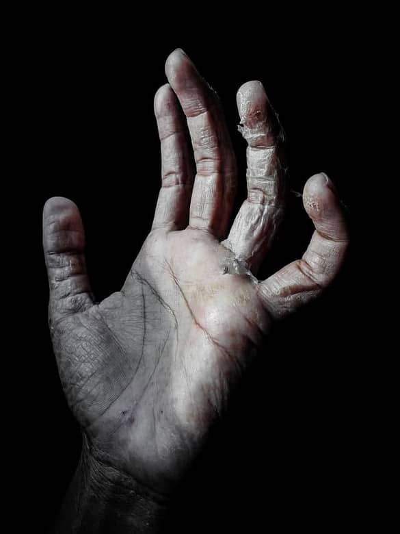 what causes eczema to flare-up